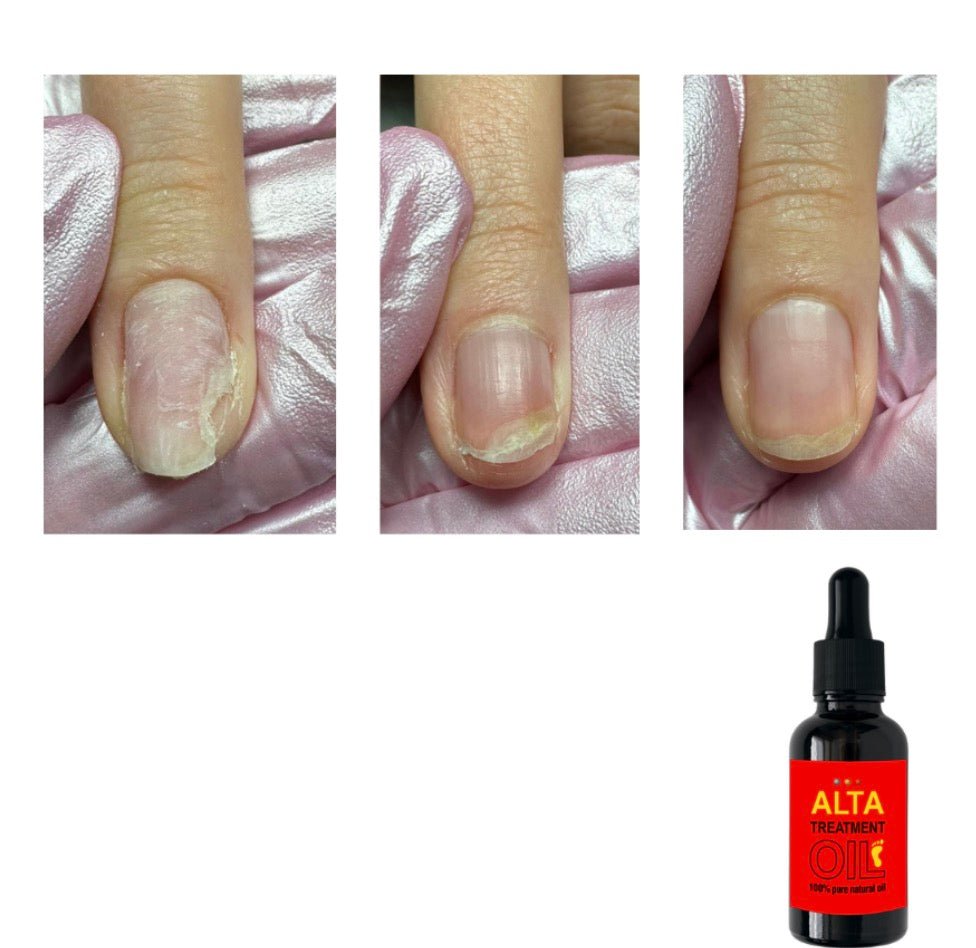 ALTA treatment oil (100% pure natural oil) ar pipeti - ilnail.com